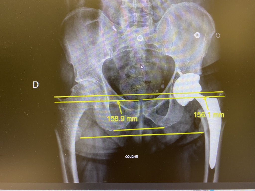 Prothèse de hanche par voie antérieure